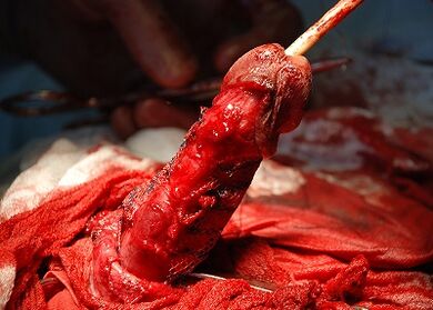 Operazione di allungamento del pene