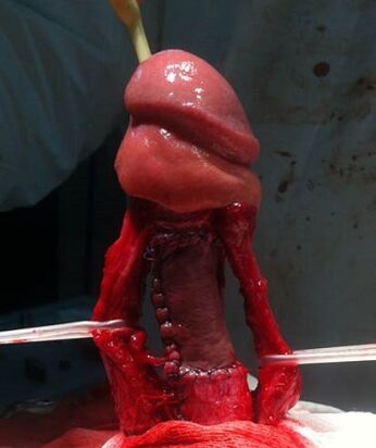 Operazione per aumentare il pene